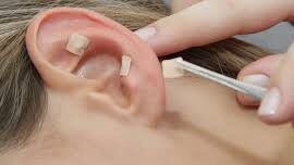 Auriculoterapia